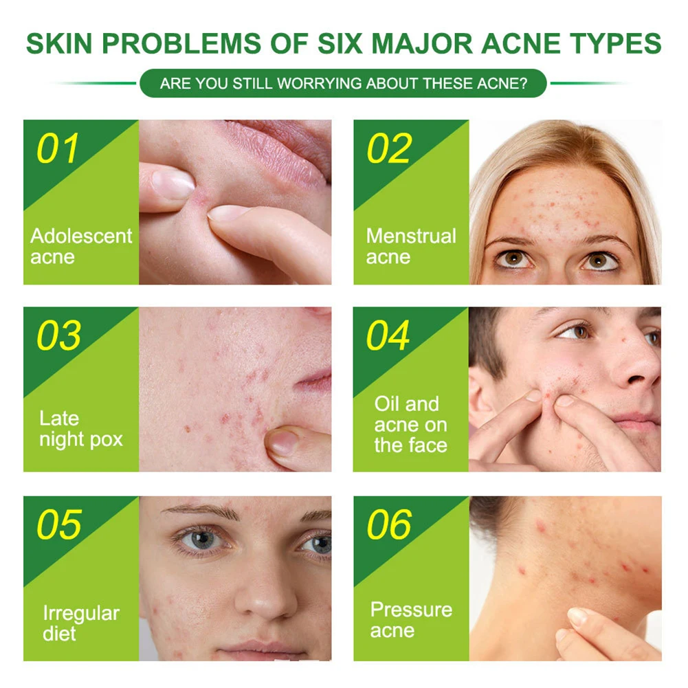 Acne Patches