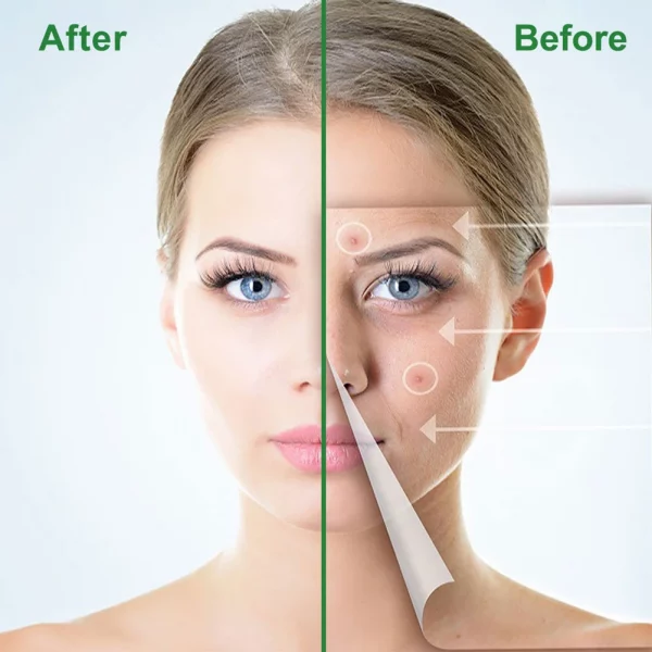 Acne Patches - Image 5